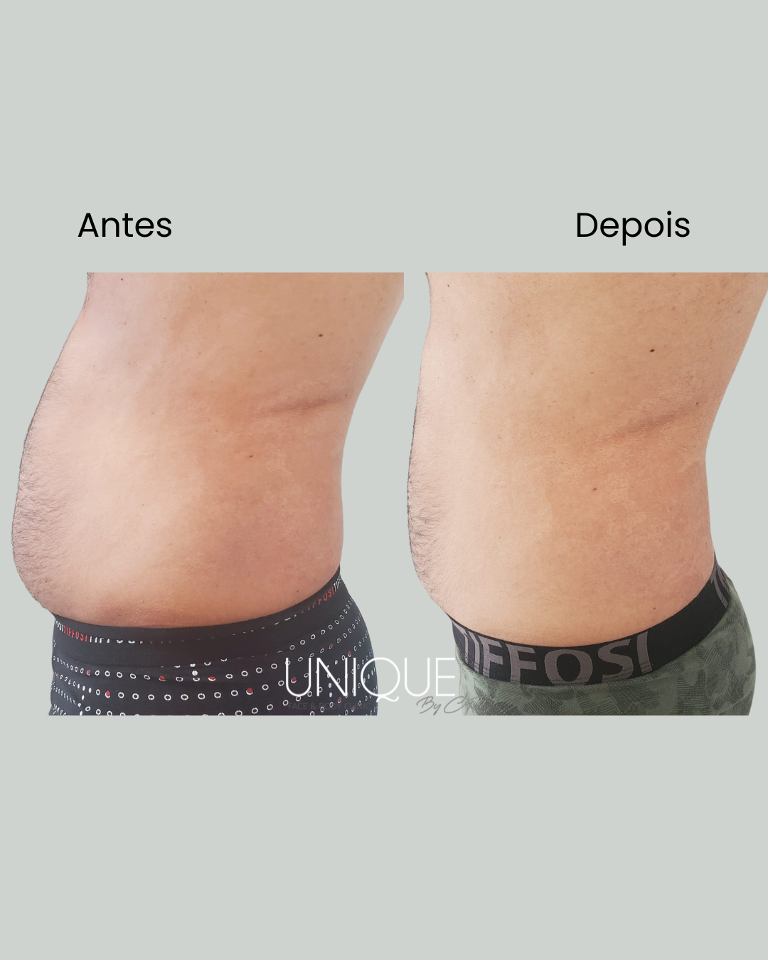 Antes e depois — perfil abdominal (mulher)