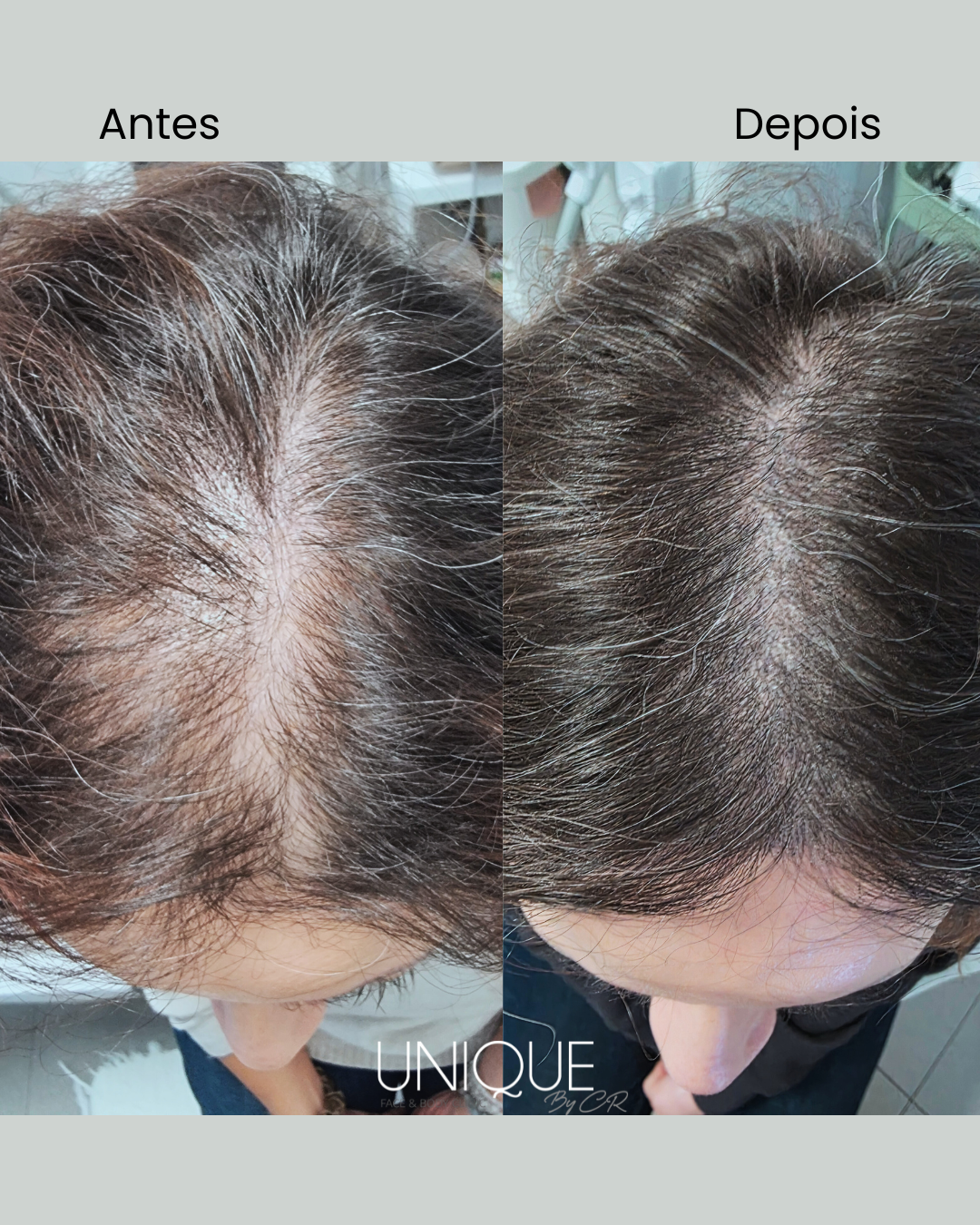 Antes e depois — densidade no risco feminino