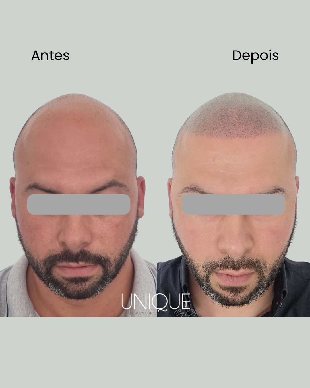 Antes e depois — reconstrução da linha frontal (homem)