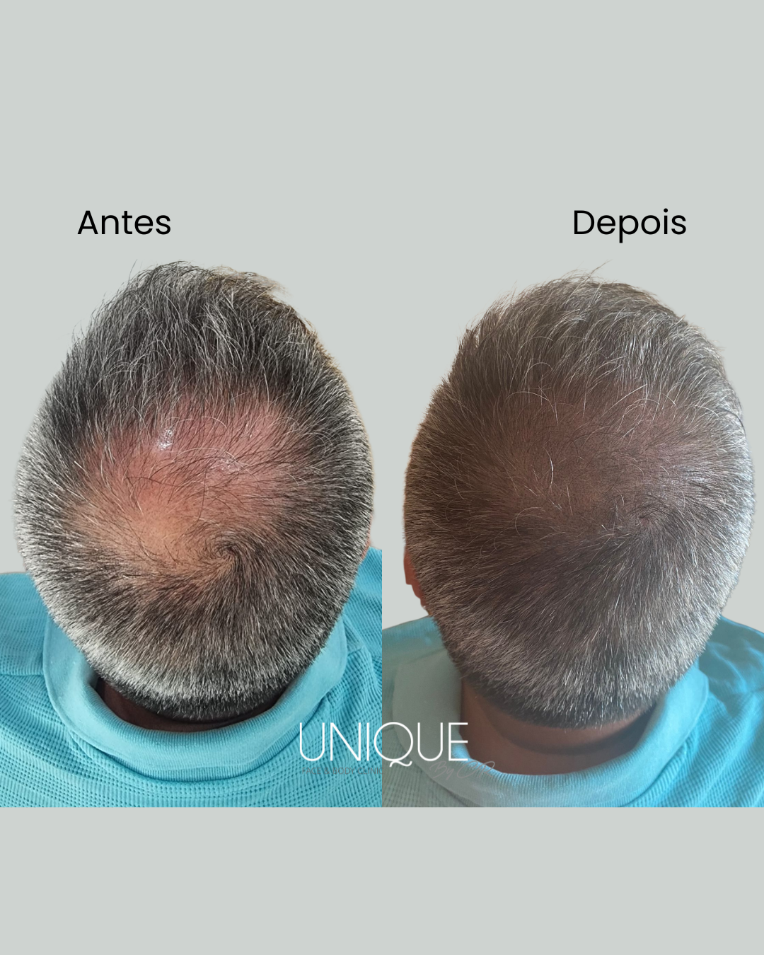 Antes e depois — micropigmentação capilar na coroa (vista superior)