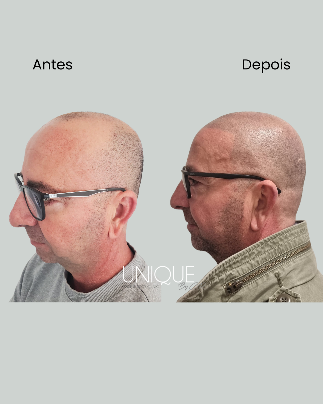 Antes e depois — micropigmentação capilar (perfil lateral, homem)