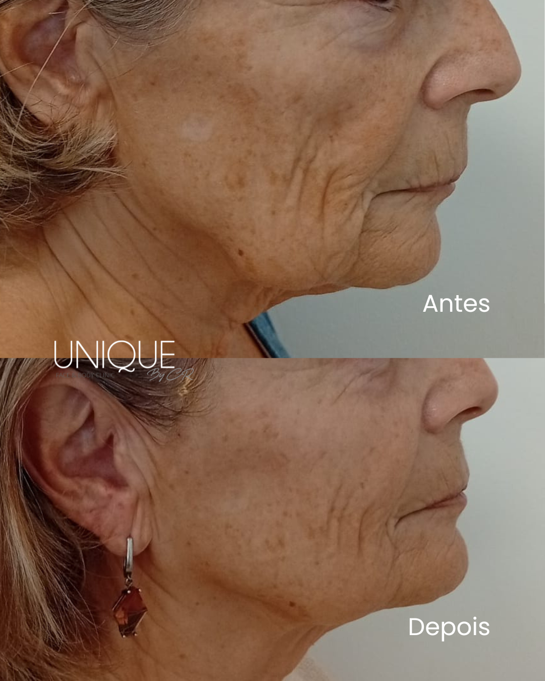 Antes e depois — rejuvenescimento de rosto e pescoço (perfil)