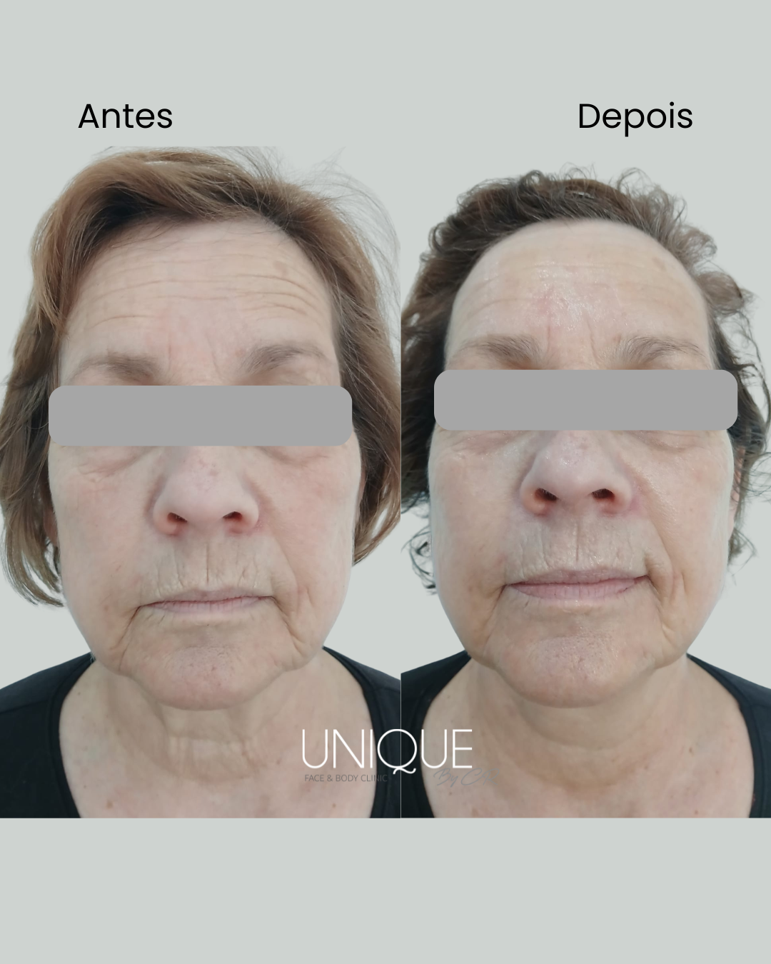 Antes e depois — redução de rugas (mulher, vista frontal)