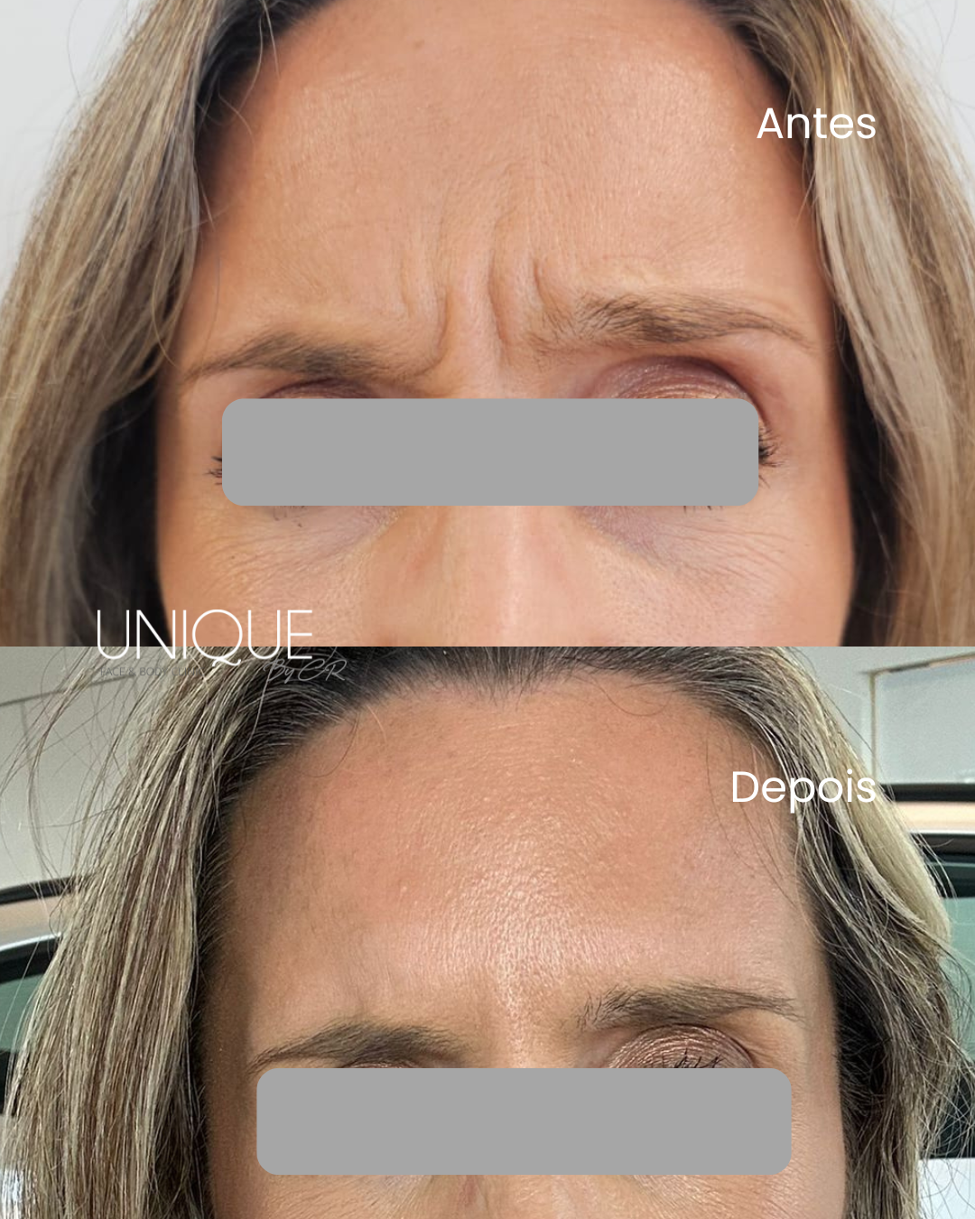 Antes e depois — toxina botulínica na testa e glabela