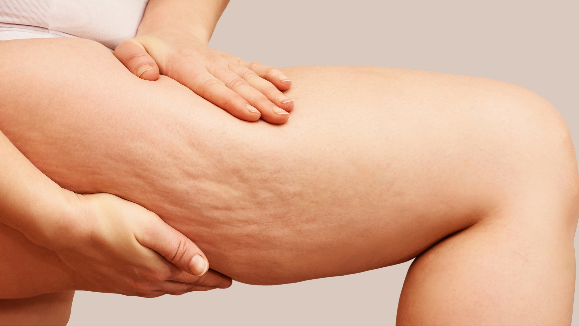 Cellulite