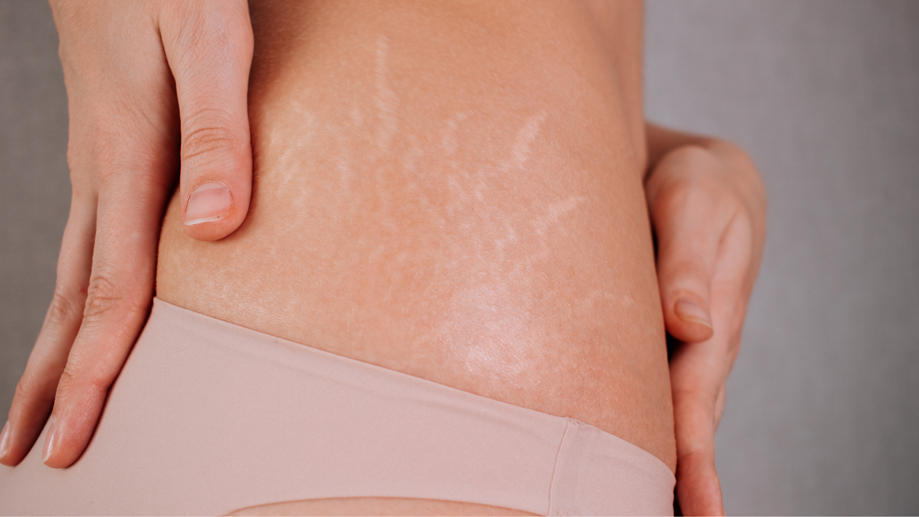 Scars and Stretch Marks