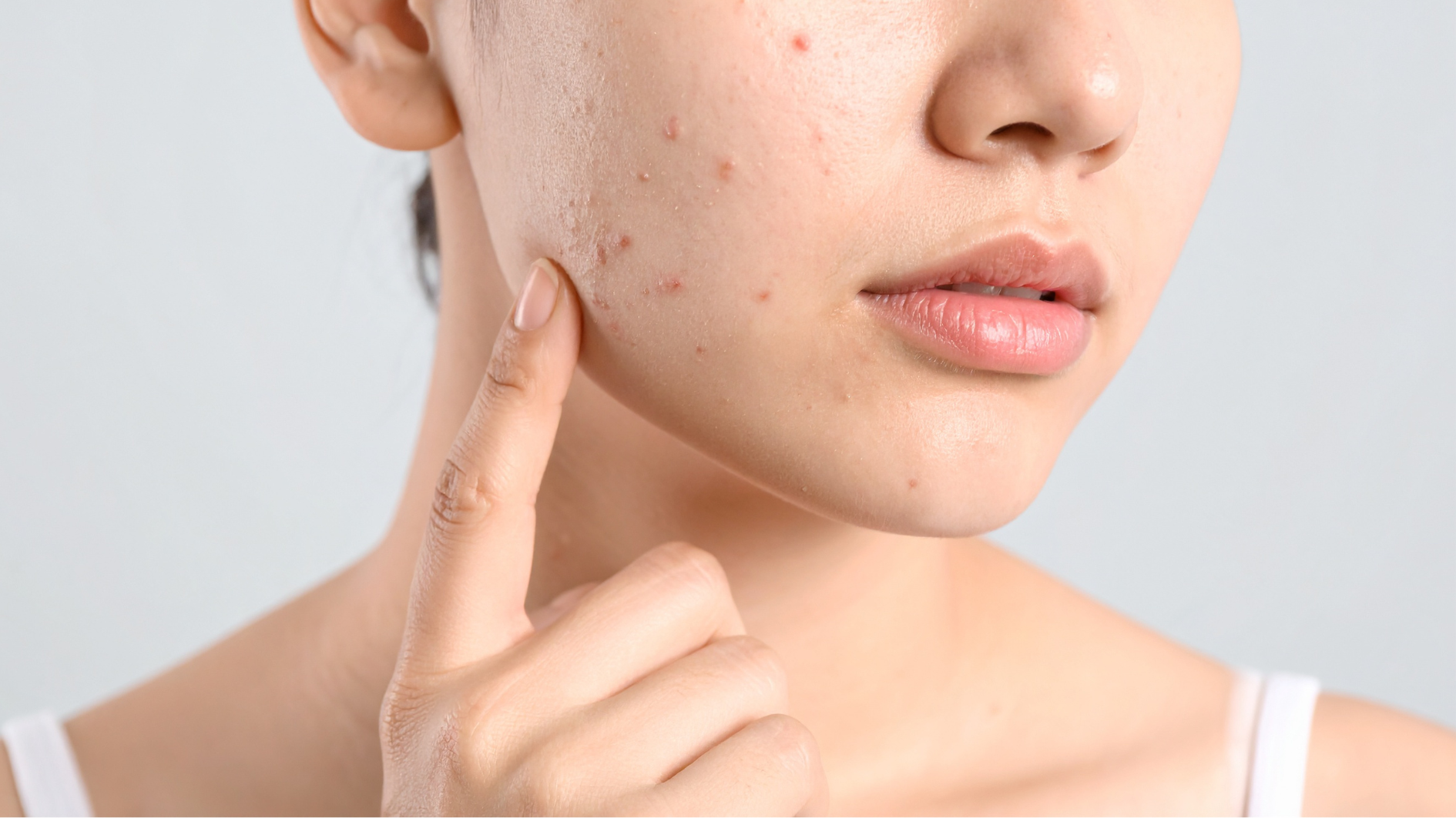 Marcas de acne